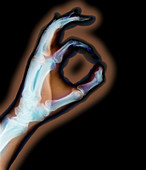 X-ray showing okay sign