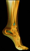 Coloured X-ray of the bones in the foot