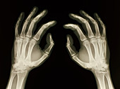 X-ray of healthy human hands
