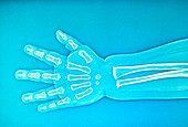 Child hand X-ray