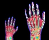 Adult and child hand X-rays