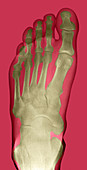 Normal foot,X-ray
