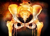 Female pelvis,coloured 3-D CT scan