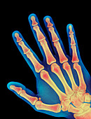 Healthy adult hand,X-ray