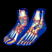 Feet,CT scan
