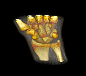 Wrist bones,CT scan
