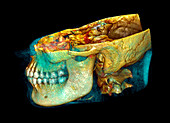 Jaw bones,CT scan