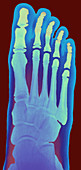 Child's foot,X-ray