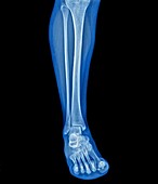 Lower leg and foot,X-ray