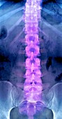 Normal lumbar spine,X-ray