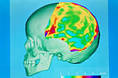 3-D CT scan of human skull showing bone thickness