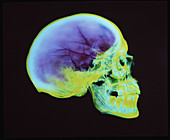 Coloured X-ray of a human skull (Roman period)