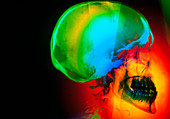 Coloured X-ray of a skull