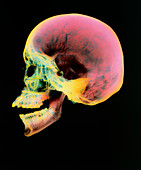 Coloured X-ray of a human skull seen from the side