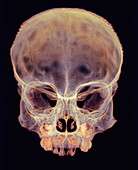 Child's skull