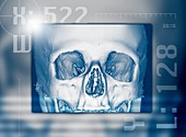 Skull,3-D CT scan