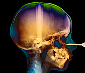Child's skull,X-ray