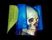 Head,CT scan