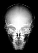 Young child's skull,X-ray