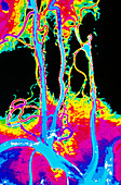 Colour angiogram of arteries in the human neck