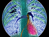 Coloured angiogram showing the pulmonary arteries