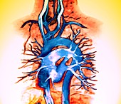 Chest blood vessels,MRA scan