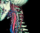 Human neck,EBT scan