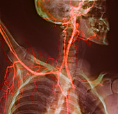 Neck and shoulder arteries,X-ray