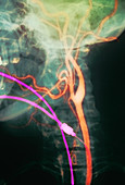 Carotid arteries,X-ray