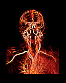 Head and neck arteries,CT scan