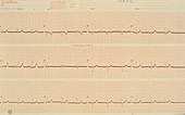 Normal heartbeat