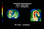 PET scan of heart showing serotonin sites