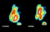 Gamma scan of the heart during diastole & systole