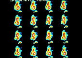 Series of gamma scans of blood flow in the heart