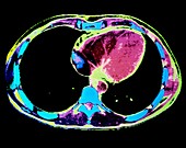 F/colour CT scan of chest showing heart and lungs