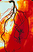Coloured angiogram of coronary artery of the heart
