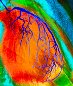 Coloured angiogram of coronary artery of the heart