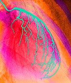 Coloured angiogram of coronary artery of the heart