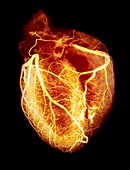 Coloured arteriogram of arteries of healthy heart