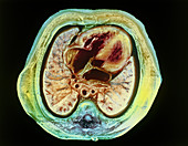 Foetus heart