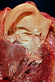Aortic valve of the heart