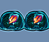 Heartbeat,MRI
