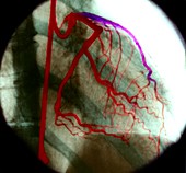 Heart arteries,X-ray