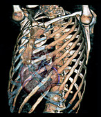 Heart and rib cage,3D CT scan