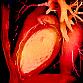 Heart and coronary arteries,3D CT scan