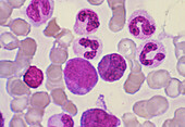 LM of bone marrow smear showing white blood cells