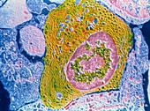 TEM of human plasmocyte