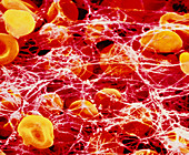 False-colour SEM of a clot occuring in human blood