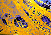 Coloured SEM of blood-clotting fibrin strands