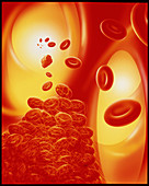 Computer artwork of a blood clot